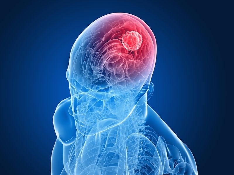 Complexity Of Brain Tumors: Advances Diagnosis, Treatment And Research